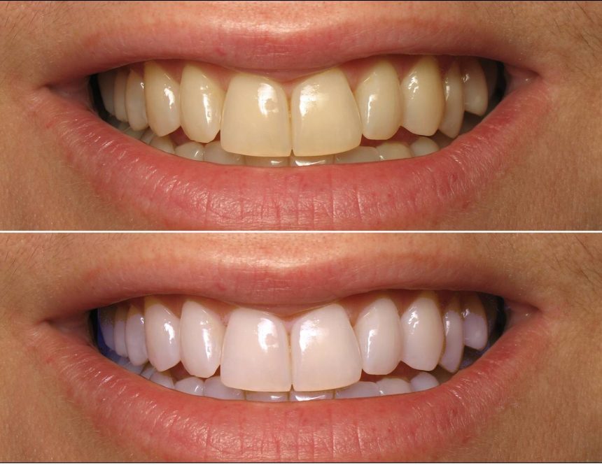 1 Hour Bleaching Dr. Mansuri's Cosmetic Dental Clinic