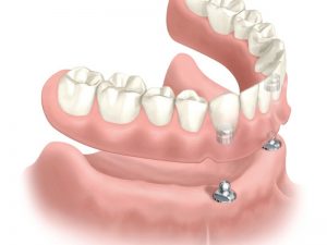  Full denture with magnetic implant